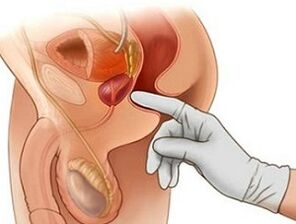 Μασάζ προστάτη για τη θεραπεία της προστατίτιδας στους άνδρες