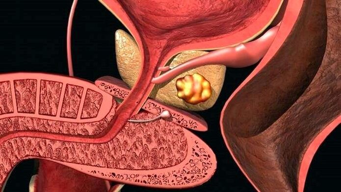 Εναπόθεση λίθων στον προστάτη με αθροιστική προστατίτιδα
